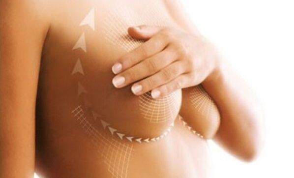 suture Lift fir Brustvergréisserung