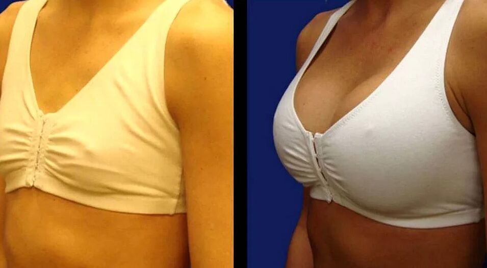 Broscht Foto virum an no der Chirurgie