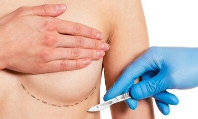 Submammaric Zougang zu Broschtverlässerung mat Implantater