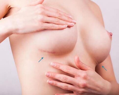 Broscht Erweiderung mat Implantater