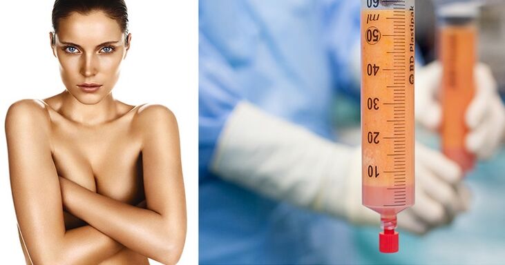 Lipofilling als Method vun der Brustvergréisserung